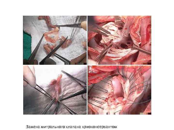Замена митрального клапана криоконсервантом 