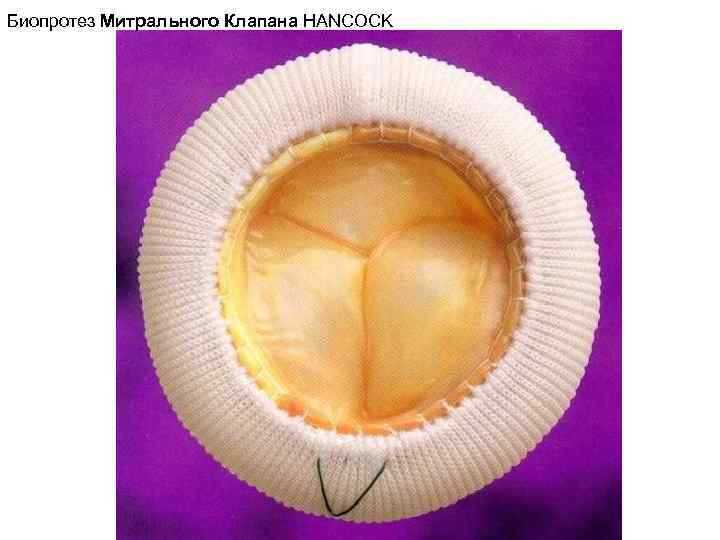Биопротез Митрального Клапана HANCOCK 