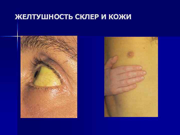 ЖЕЛТУШНОСТЬ СКЛЕР И КОЖИ 