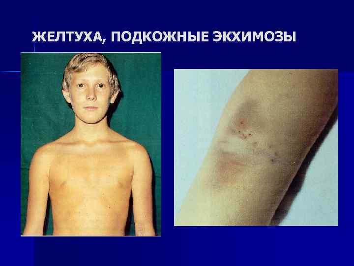ЖЕЛТУХА, ПОДКОЖНЫЕ ЭКХИМОЗЫ 