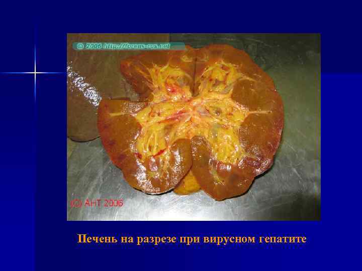  Печень на разрезе при вирусном гепатите 