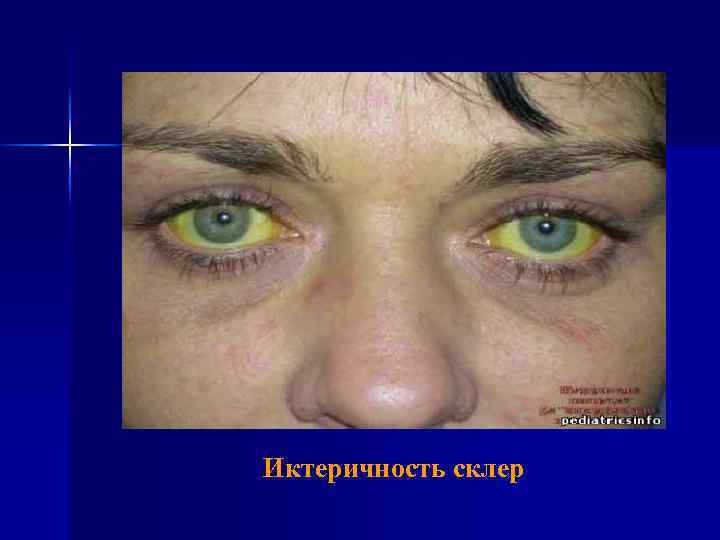  Иктеричность склер 