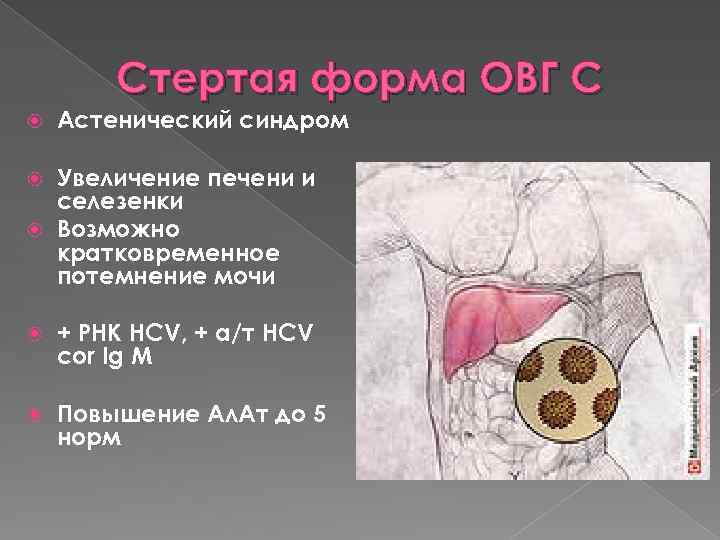 Стертая форма ОВГ С Астенический синдром Увеличение печени и селезенки Возможно кратковременное потемнение мочи