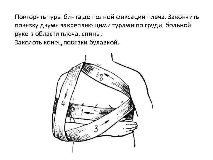 Повторять туры бинта до полной фиксации плеча. Закончить повязку двумя закрепляющими турами по груди,