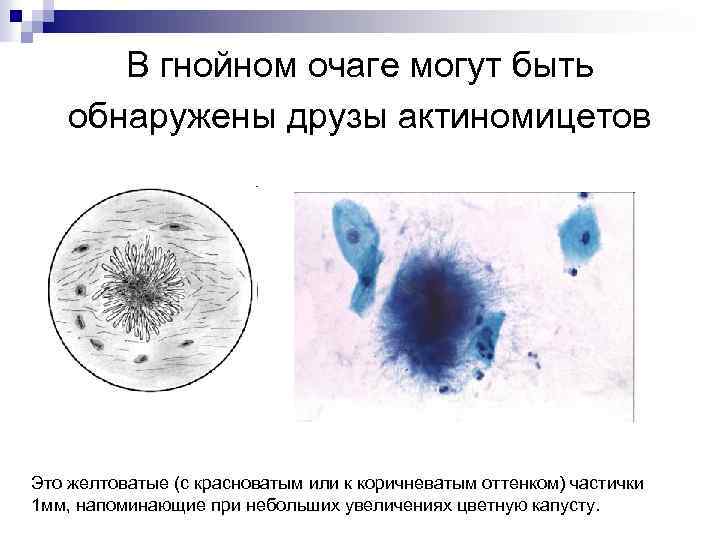 В гнойном очаге могут быть обнаружены друзы актиномицетов Это желтоватые (с красноватым или к