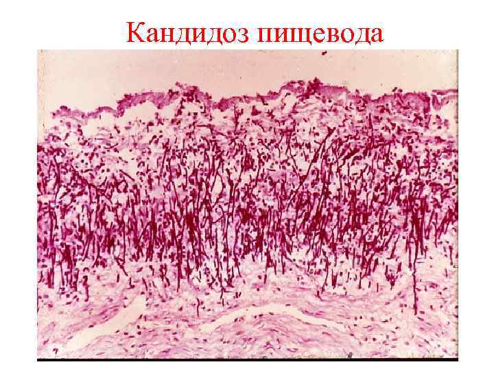 Кандидоз пищевода 