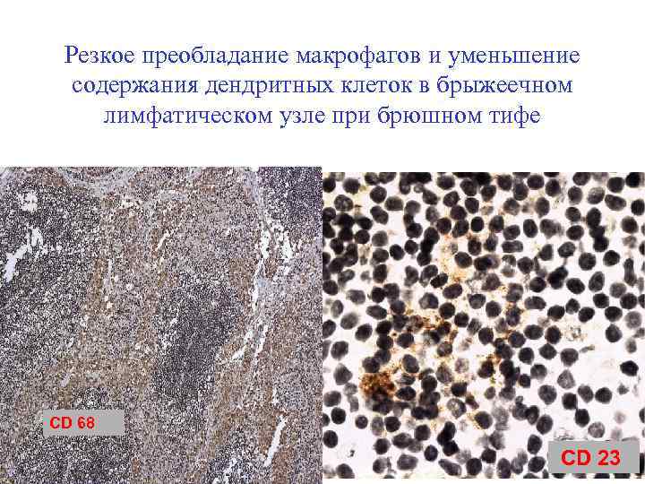 Резкое преобладание макрофагов и уменьшение содержания дендритных клеток в брыжеечном лимфатическом узле при брюшном