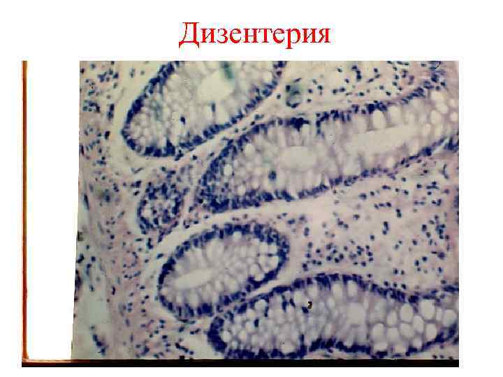 Дизентерия 