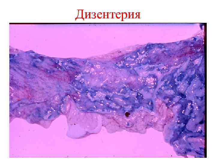 Дизентерия презентация патанатомия