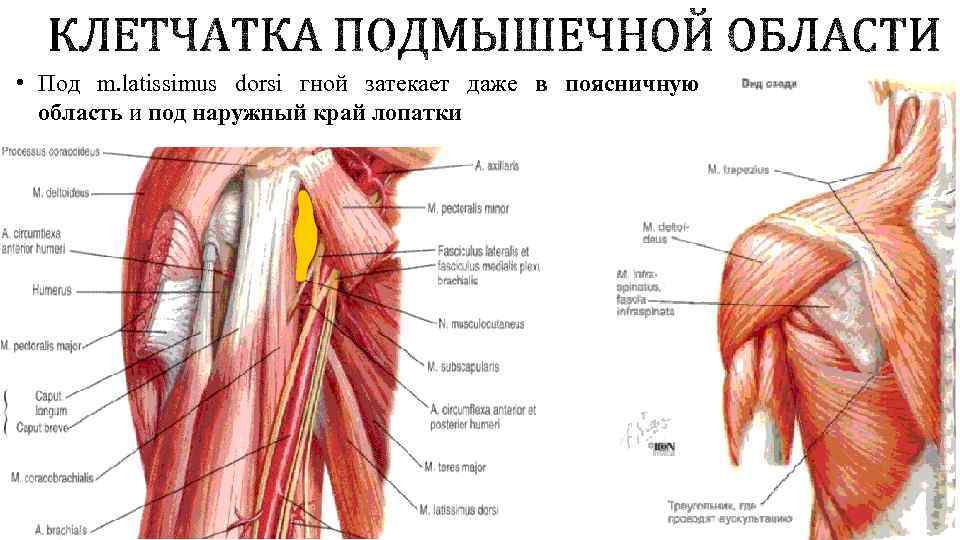  • Под m. latissimus dorsi гной затекает даже в поясничную область и под