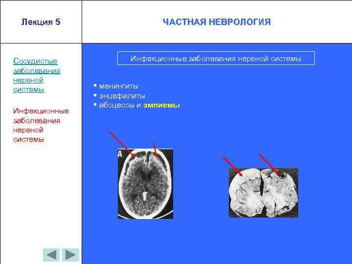 Лекция 5 Сосудистые заболевания нервной системы Инфекционные заболевания нервной системы ЧАСТНАЯ НЕВРОЛОГИЯ Инфекционные заболевания