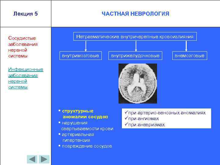 Лекция 5 Сосудистые заболевания нервной системы ЧАСТНАЯ НЕВРОЛОГИЯ Нетравматические внутричерепные кровоизлияния внутримозговые внутрижелудочковые внемозговые