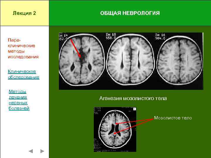 Гипоплазия правой головного мозга. Агенезия мозолистого тела на кт. Недоразвитие мозолистого тела. Полная агенезия мозолистого тела. Гипоплазия/аплазия мозолистого тела.