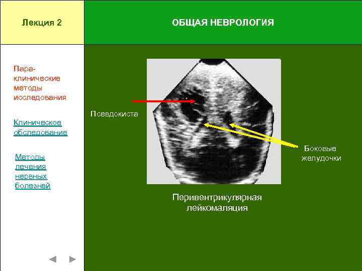 Лекция 2 ОБЩАЯ НЕВРОЛОГИЯ Параклинические методы исследования Клиническое обследование Псевдокиста Боковые желудочки Методы лечения