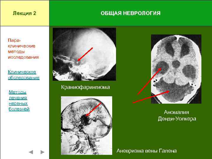 Лекция 2 ОБЩАЯ НЕВРОЛОГИЯ Параклинические методы исследования Клиническое обследование Методы лечения нервных болезней Краниофарингиома