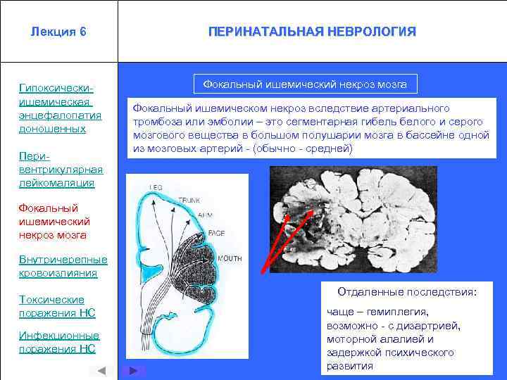 Лекция 6 Гипоксическиишемическая энцефалопатия доношенных Перивентрикулярная лейкомаляция Фокальный ишемический некроз мозга ПЕРИНАТАЛЬНАЯ НЕВРОЛОГИЯ Фокальный