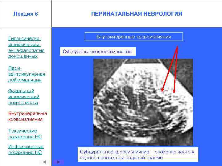 Лекция 6 Гипоксическиишемическая энцефалопатия доношенных ПЕРИНАТАЛЬНАЯ НЕВРОЛОГИЯ Внутричерепные кровоизлияния Субдуральное кровоизлияние Перивентрикулярная лейкомаляция Фокальный