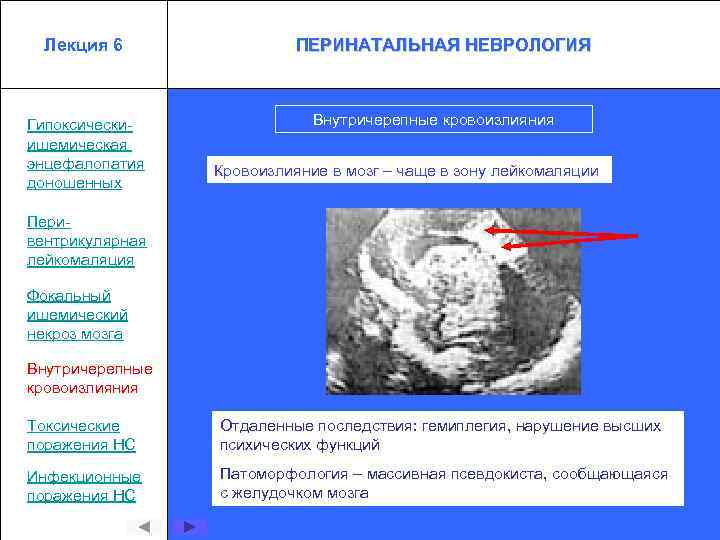 Лекция 6 Гипоксическиишемическая энцефалопатия доношенных ПЕРИНАТАЛЬНАЯ НЕВРОЛОГИЯ Внутричерепные кровоизлияния Кровоизлияние в мозг – чаще