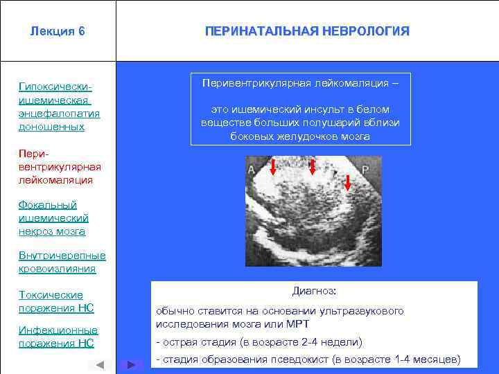 Лекция 6 Гипоксическиишемическая энцефалопатия доношенных ПЕРИНАТАЛЬНАЯ НЕВРОЛОГИЯ Перивентрикулярная лейкомаляция – это ишемический инсульт в