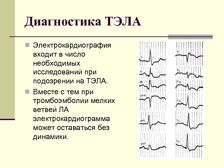 Диагностика ТЭЛА n Электрокардиография входит в число необходимых исследований при подозрении на ТЭЛА. n