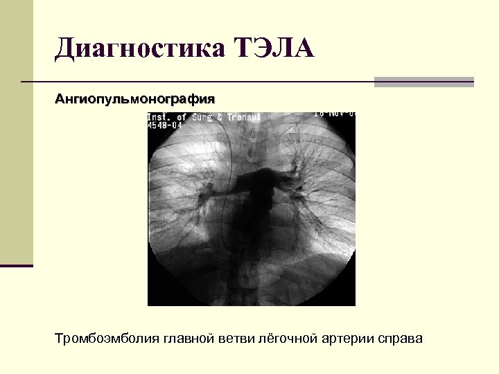 Диагностика ТЭЛА Ангиопульмонография Тромбоэмболия главной ветви лёгочной артерии справа 