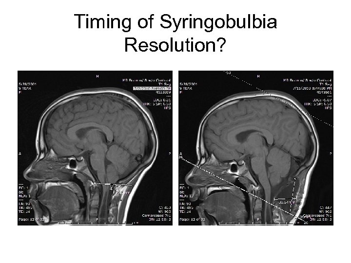 Timing of Syringobulbia Resolution? 