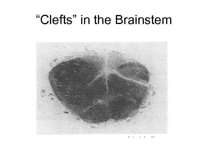 “Clefts” in the Brainstem 