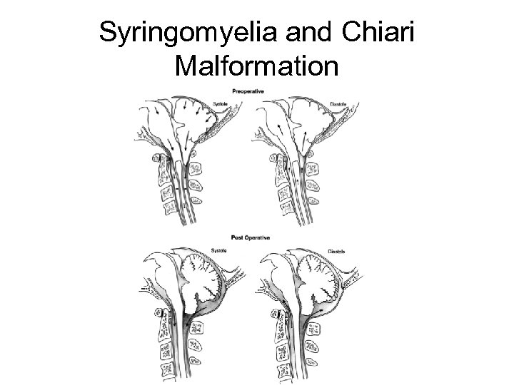 Syringomyelia and Chiari Malformation 