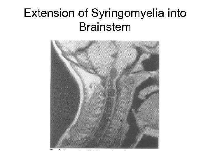 Extension of Syringomyelia into Brainstem 