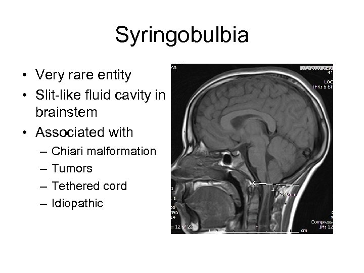 Syringobulbia • Very rare entity • Slit-like fluid cavity in brainstem • Associated with