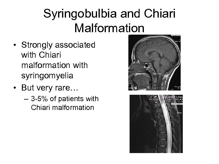 Syringobulbia and Chiari Malformation • Strongly associated with Chiari malformation with syringomyelia • But