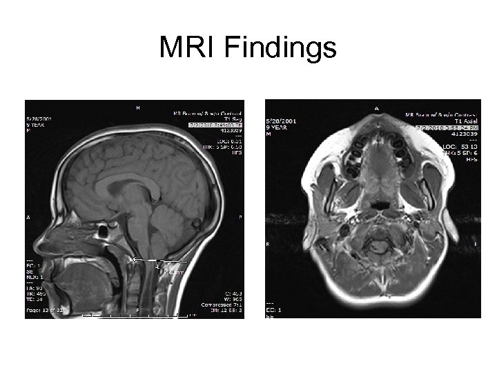 MRI Findings 