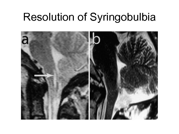 Resolution of Syringobulbia 