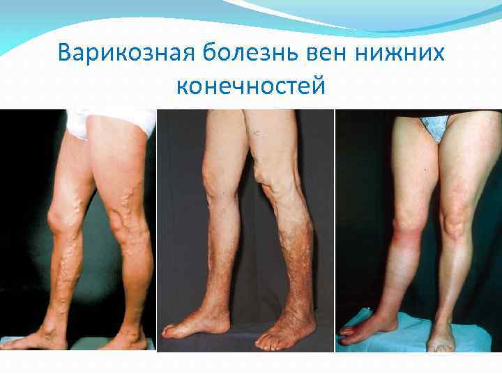 Варикозная болезнь вен нижних конечностей 