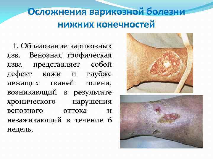 Осложнения варикозной болезни нижних конечностей I. Образование варикозных язв. Венозная трофическая язва представляет собой