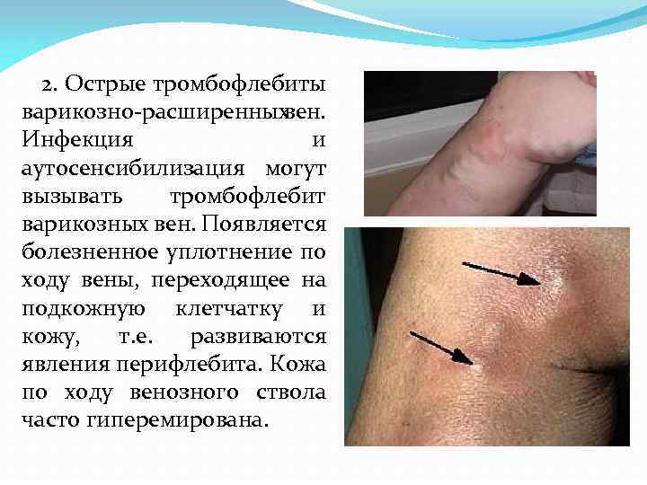 2. Острые тромбофлебиты варикозно расширенных вен. Инфекция и аутосенсибилизация могут вызывать тромбофлебит варикозных вен.