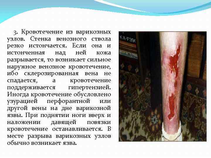 3. Кровотечение из варикозных узлов. Стенка венозного ствола резко истончается. Если она и истонченная