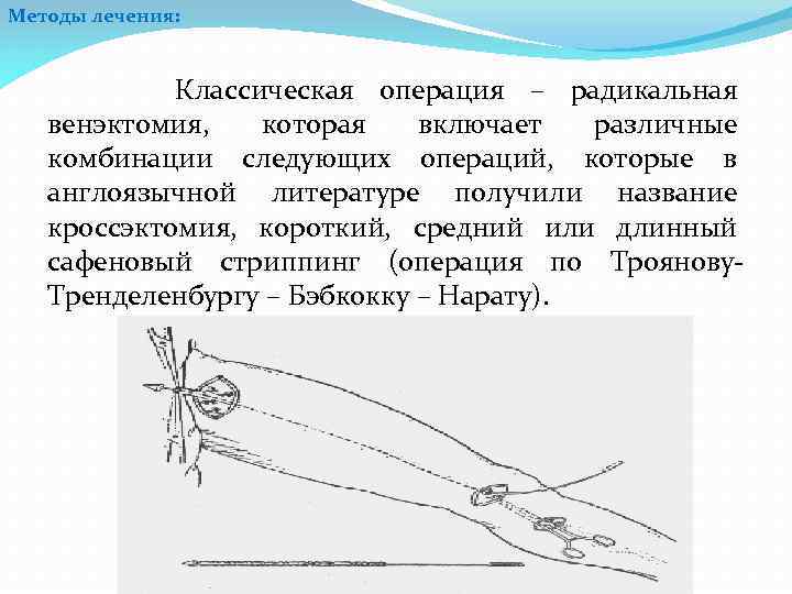 Методы лечения: Классическая операция – радикальная венэктомия, которая включает различные комбинации следующих операций, которые