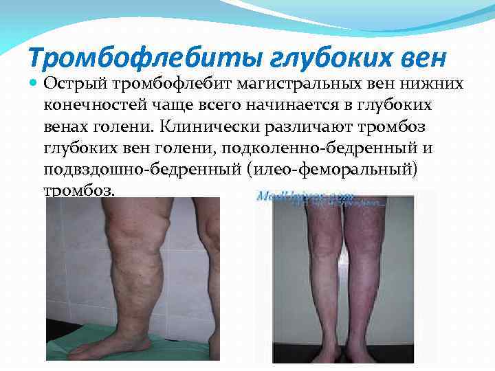 Тромбофлебиты глубоких вен Острый тромбофлебит магистральных вен нижних конечностей чаще всего начинается в глубоких