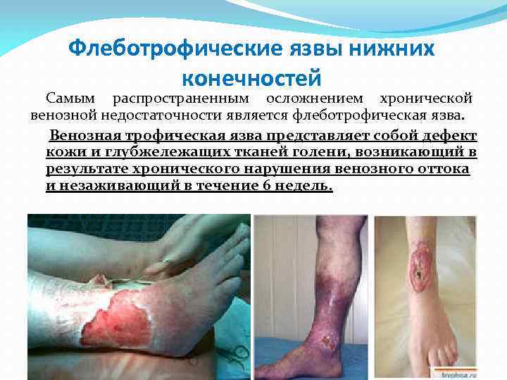 Флеботрофические язвы нижних конечностей Самым распространенным осложнением хронической венозной недостаточности является флеботрофическая язва. Венозная