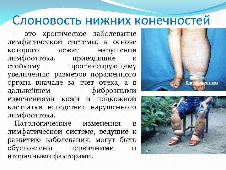 Слоновость нижних конечностей – это хроническое заболевание лимфатической системы, в основе которого лежат нарушения