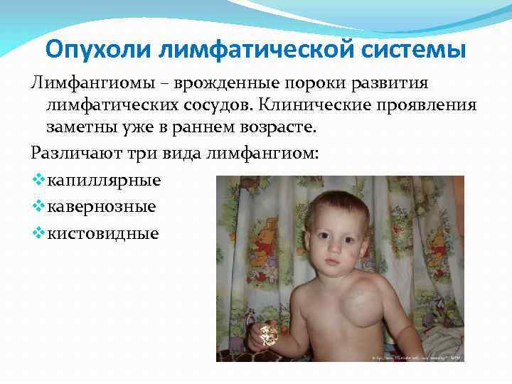 Опухоли лимфатической системы Лимфангиомы – врожденные пороки развития лимфатических сосудов. Клинические проявления заметны уже