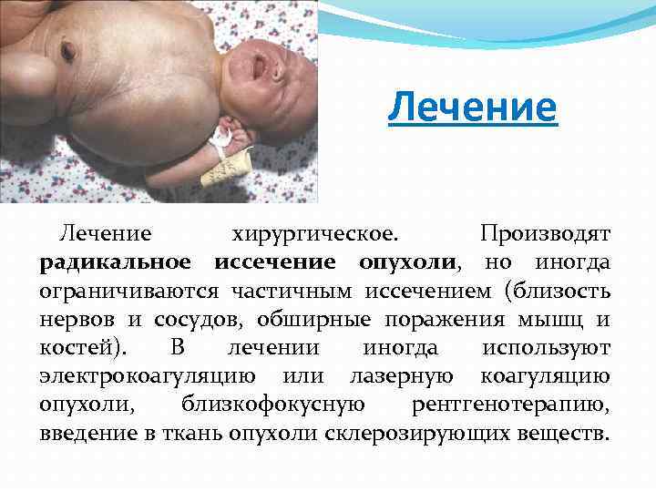 Лечение хирургическое. Производят радикальное иссечение опухоли, но иногда ограничиваются частичным иссечением (близость нервов и