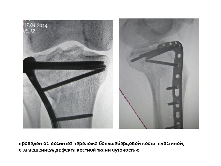 проведен остеосинтез перелома большеберцовой кости пластиной, с замещением дефекта костной ткани аутокостью 