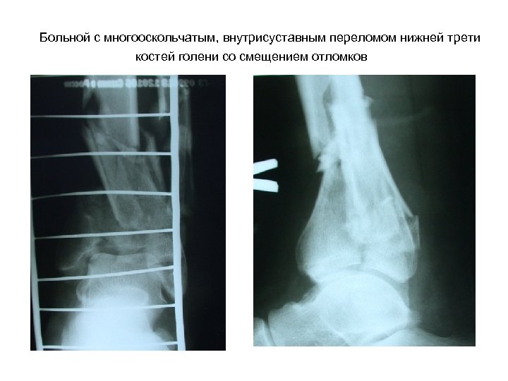 Больной с многооскольчатым, внутрисуставным переломом нижней трети костей голени со смещением отломков 