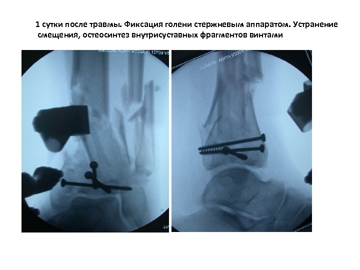 1 сутки после травмы. Фиксация голени стержневым аппаратом. Устранение смещения, остеосинтез внутрисуставных фрагментов винтами