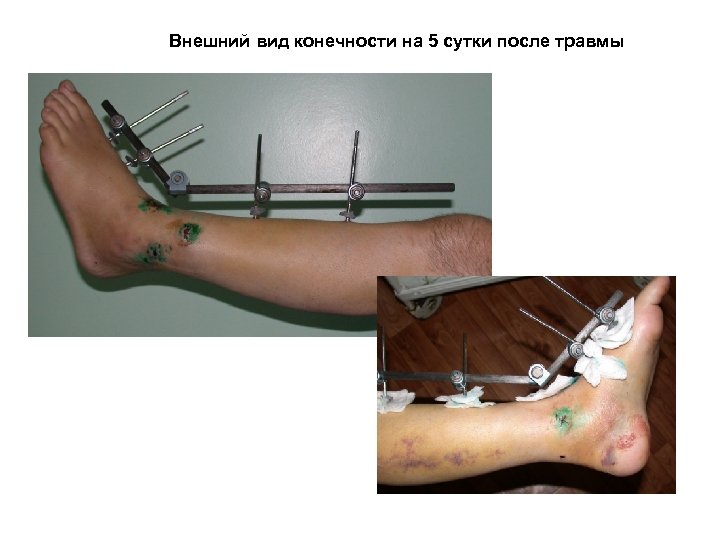 Внешний вид конечности на 5 сутки после травмы 