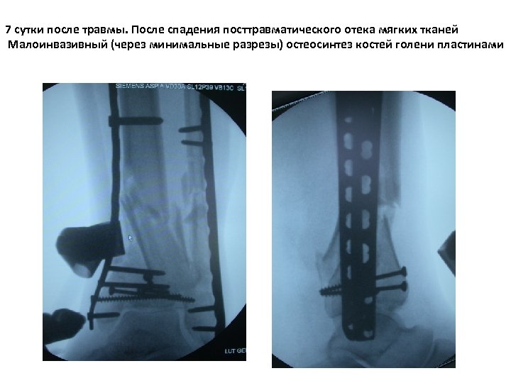 7 сутки после травмы. После спадения посттравматического отека мягких тканей Малоинвазивный (через минимальные разрезы)