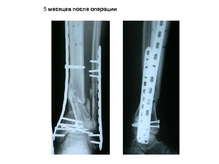 5 месяцев после операции 