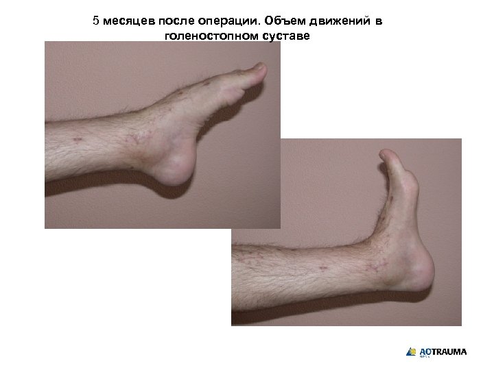 5 месяцев после операции. Объем движений в голеностопном суставе 